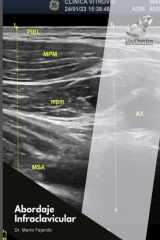 Abordaje Infraclavicular cover image